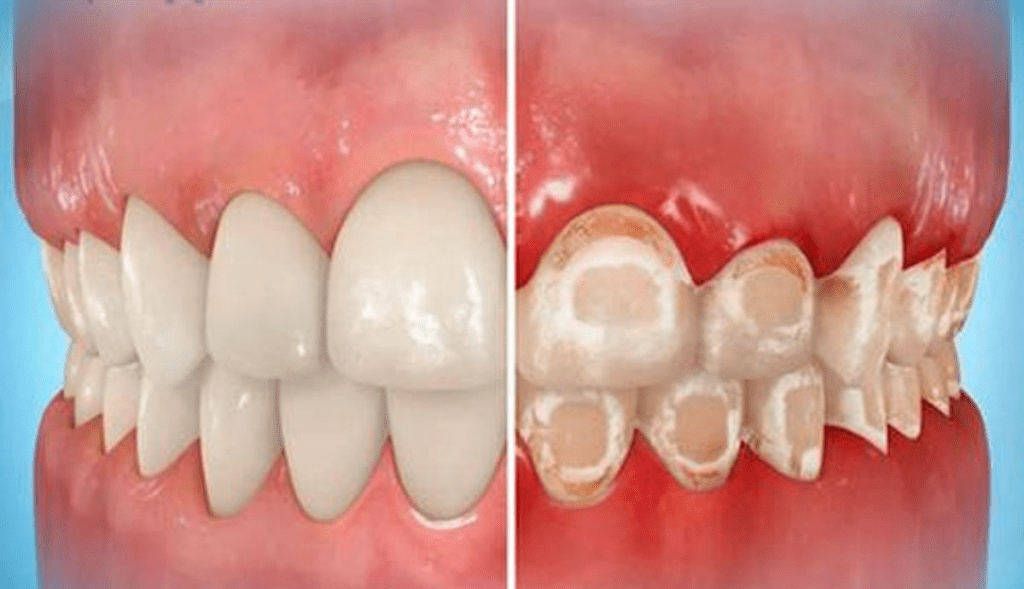 5 Early Symptoms of Tooth Decay and their Methods of Prevention
